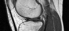 MRT (Magnetresonanz Tomographie)